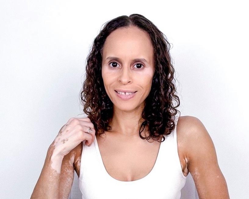 A moment that changed me: I felt hugely self conscious about my skin - until I had a revelation
