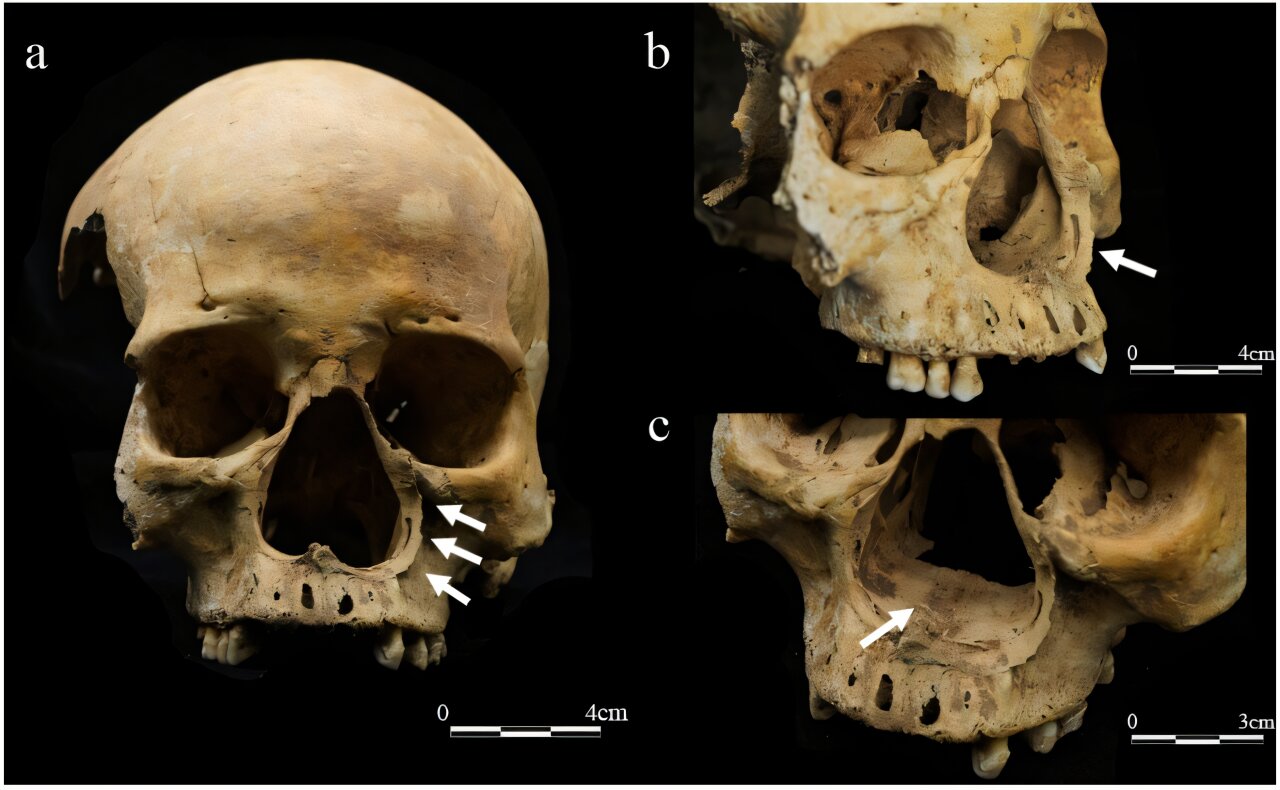 Medieval Chinese skeleton may reveal first evidence of a brutal punishment