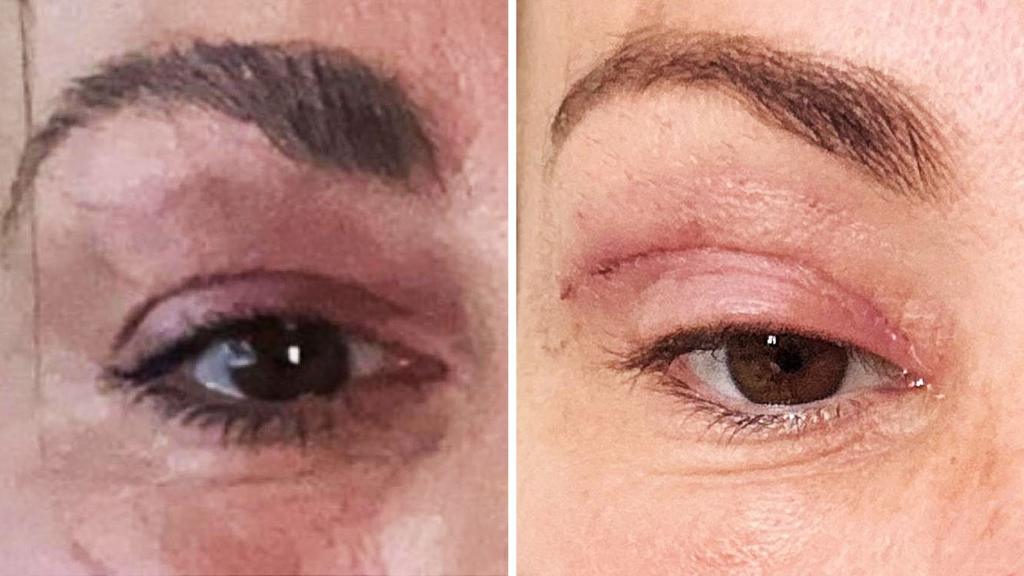 'My eyelids became infected - I was scared to sleep'