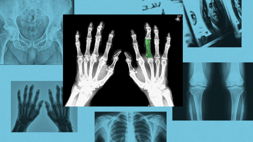 STAT+: Drugmakers, biotech VCs show ‘reinvigorated’ interest in osteoporosis treatments