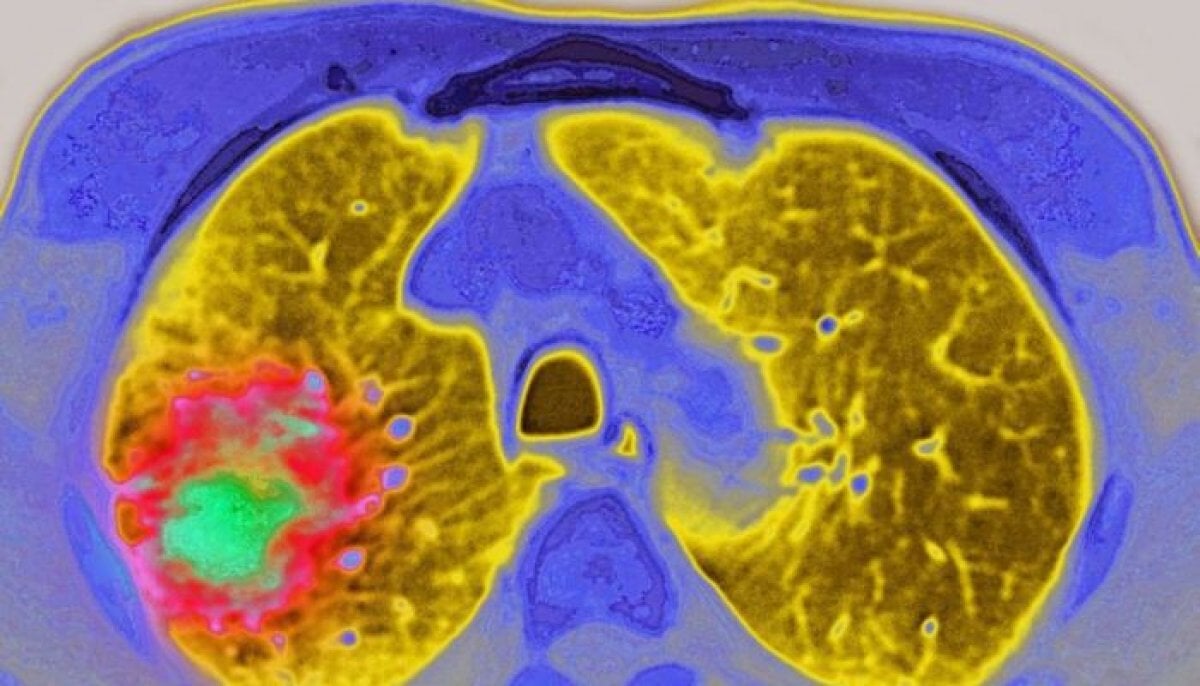 New Amgen drug combination shows survival gains in lung cancer trial