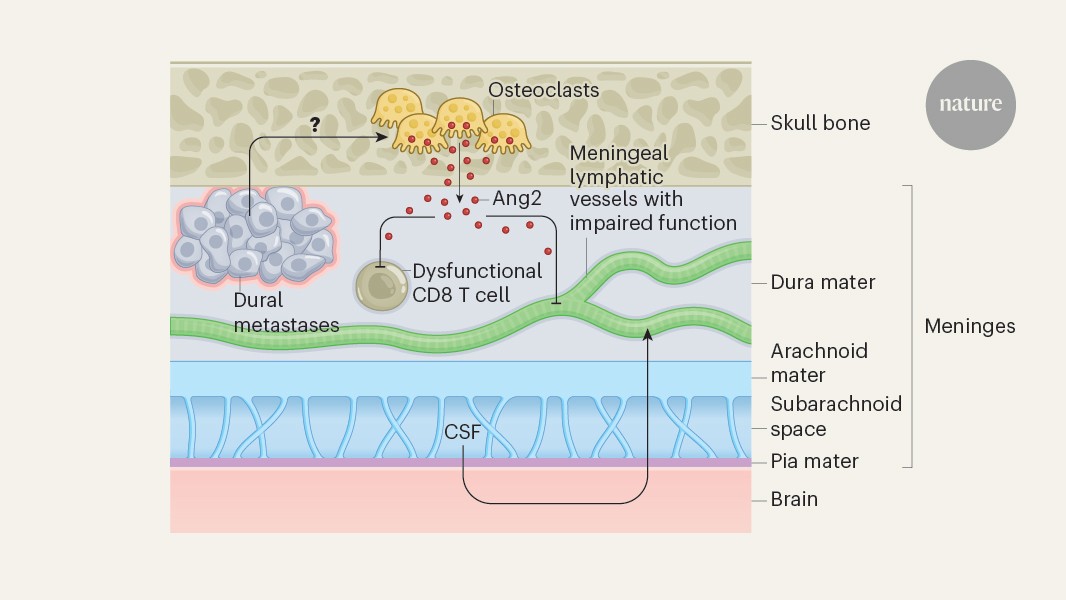 Pipework problems when cancer spreads to an area bordering the brain