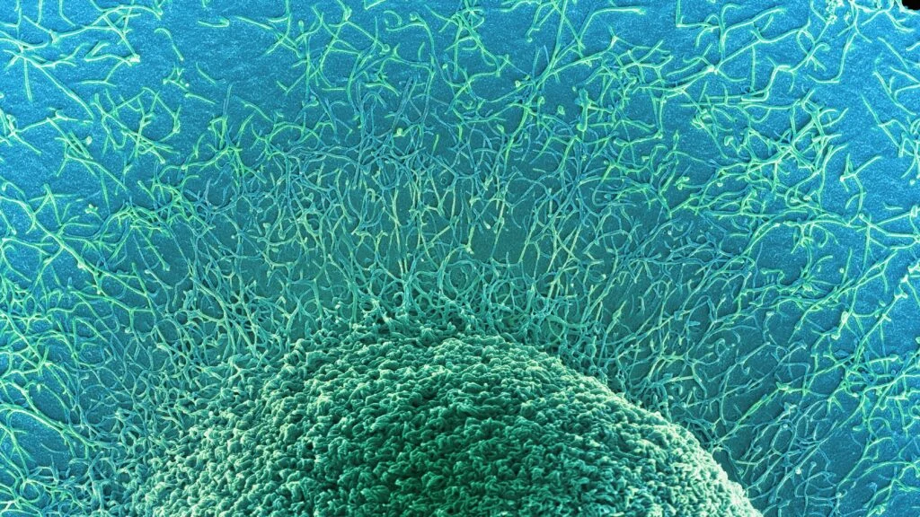 STAT+: New atlas of colorectal tumors sheds light on why cancers in young people are more dangerous